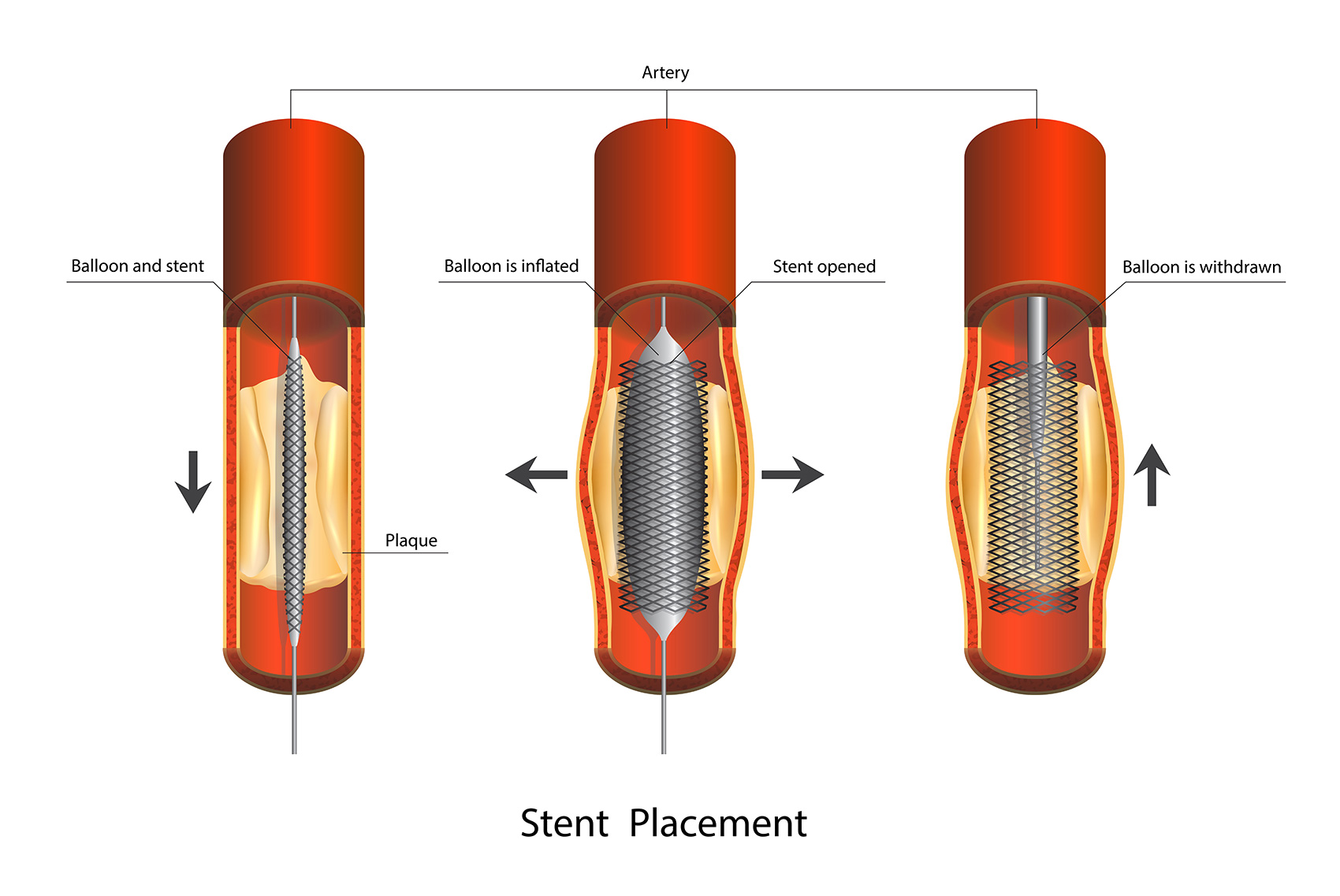 Angioplasty Stent Balloon