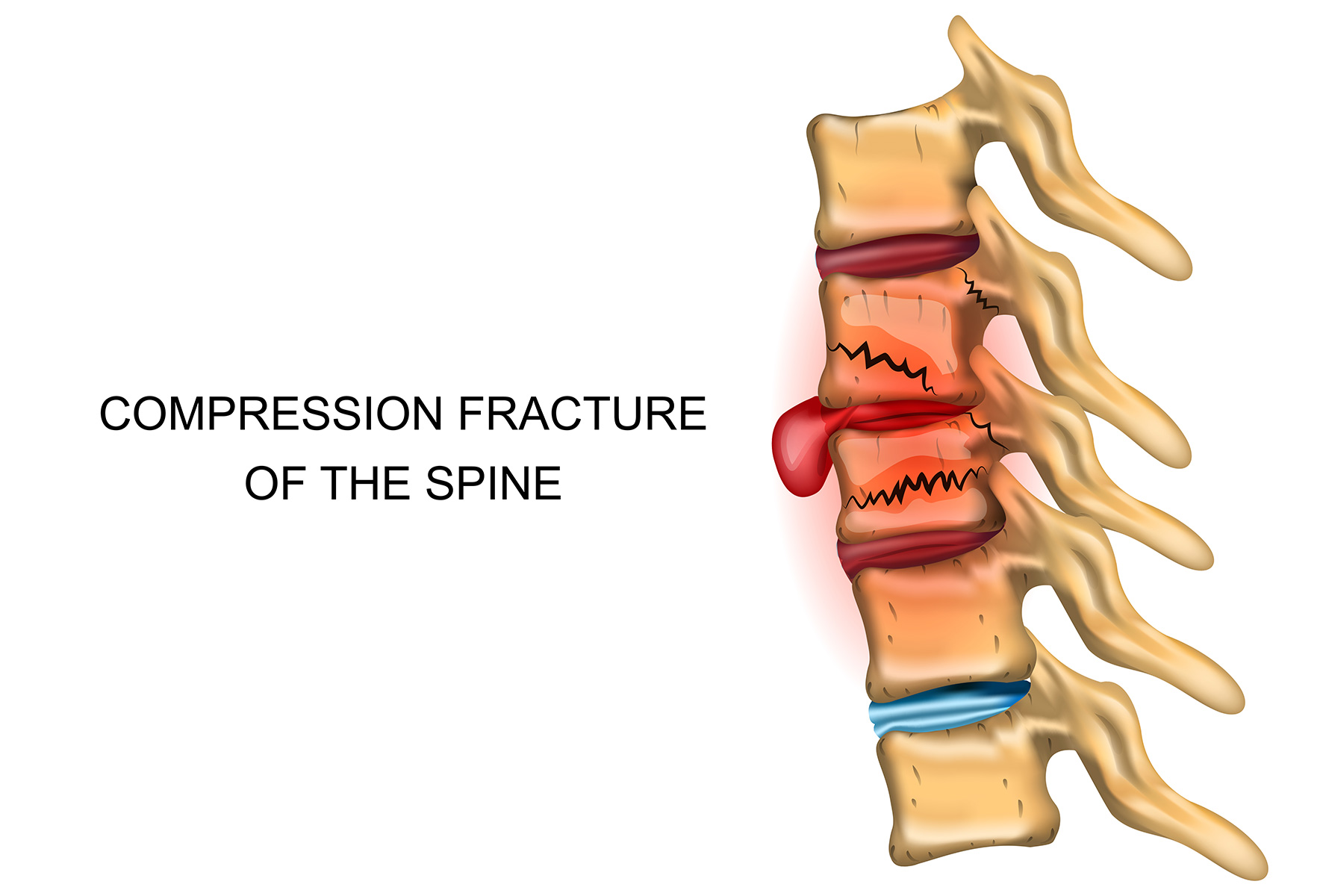 Compression Fracture