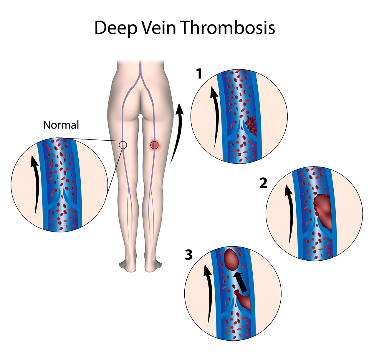 DVT Deep Vein Thrombosis