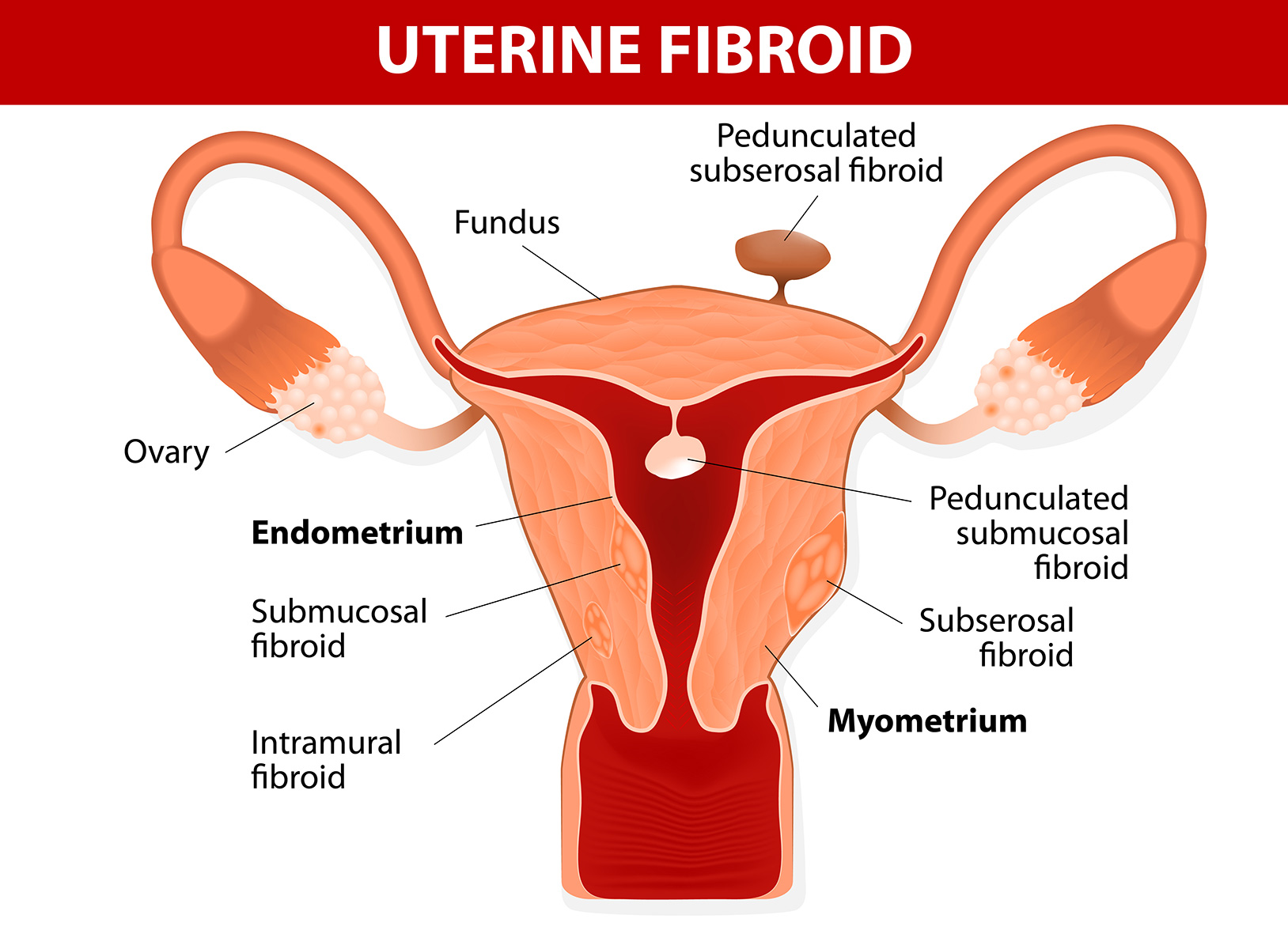 Uterine Fibroid