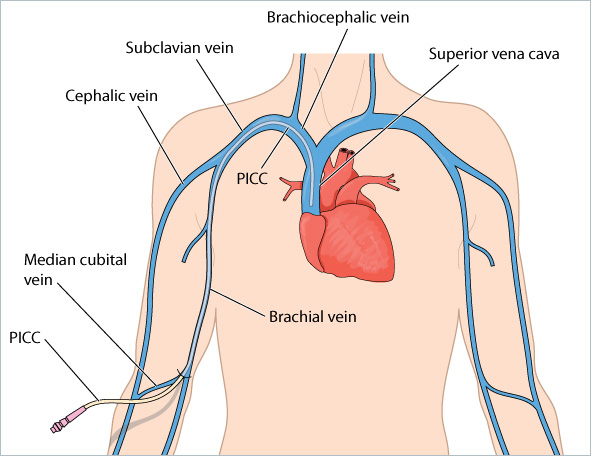 PICC Line