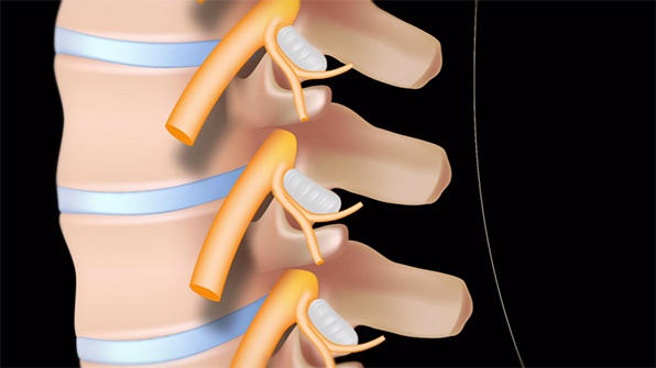 Facet Joint Injection